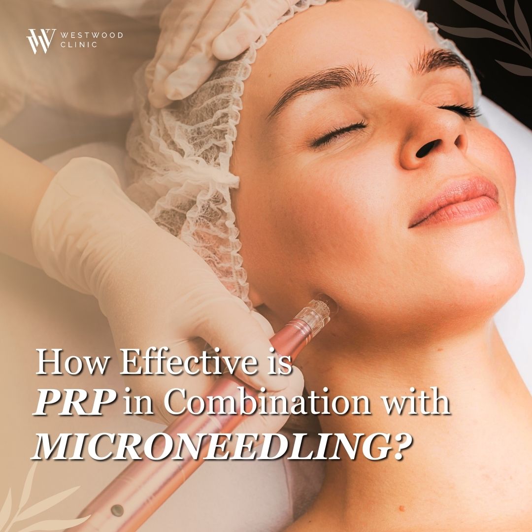 prp and microneedling