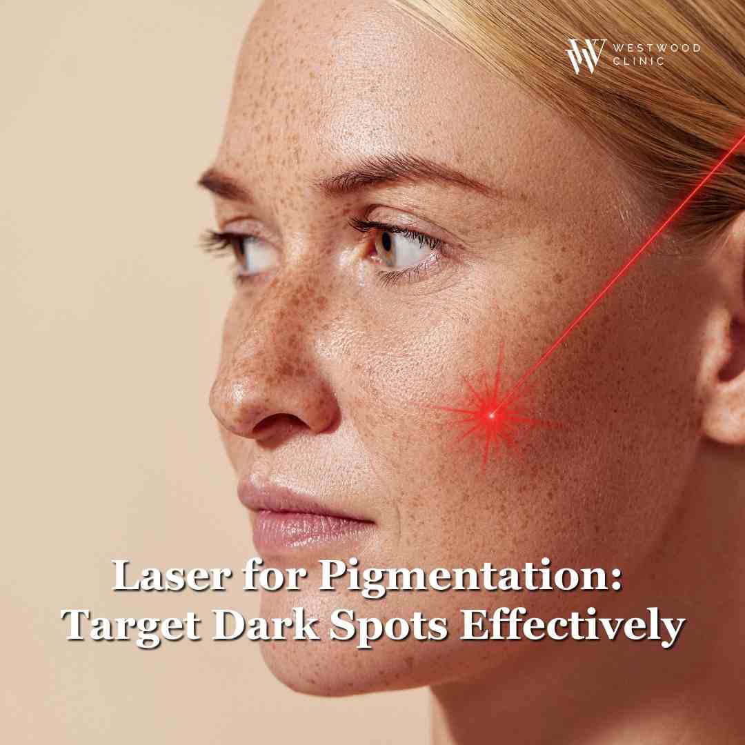 laser for pigmentation