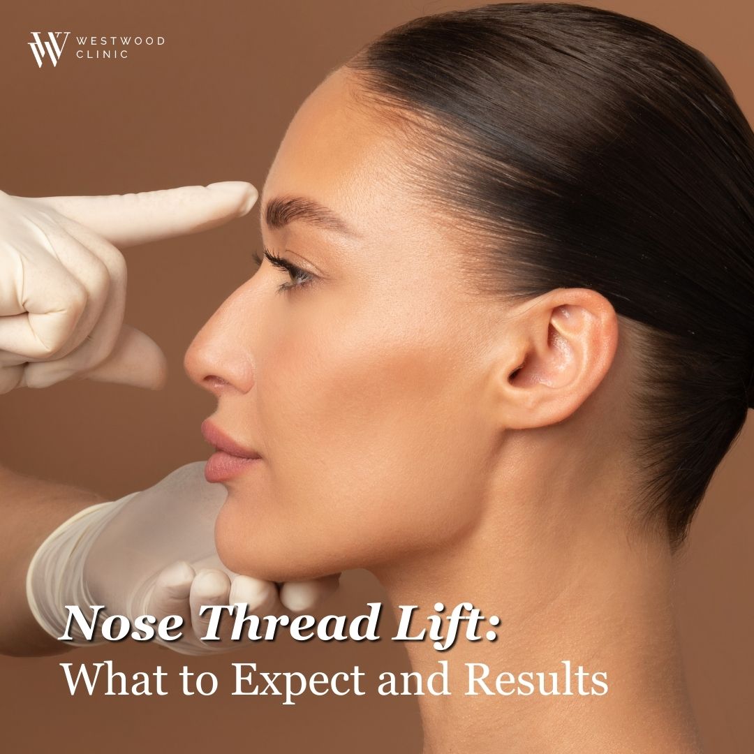 nose thread lift